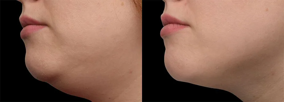 Emface before and after