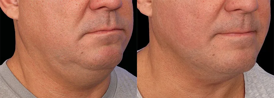 Emface before and after