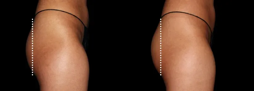 Emsculpt Neo - Before and After