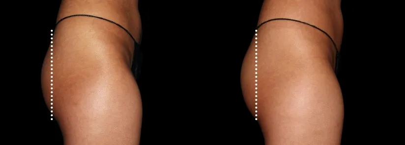 Emsculpt Neo before and after