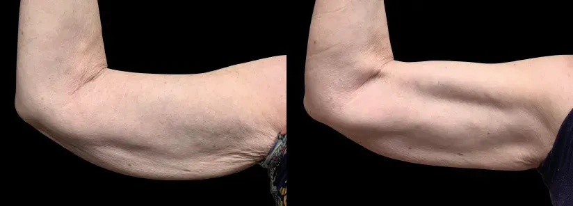 Emsculpt Neo - Before and After
