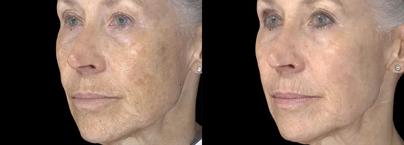 Exion Clear RF before and after