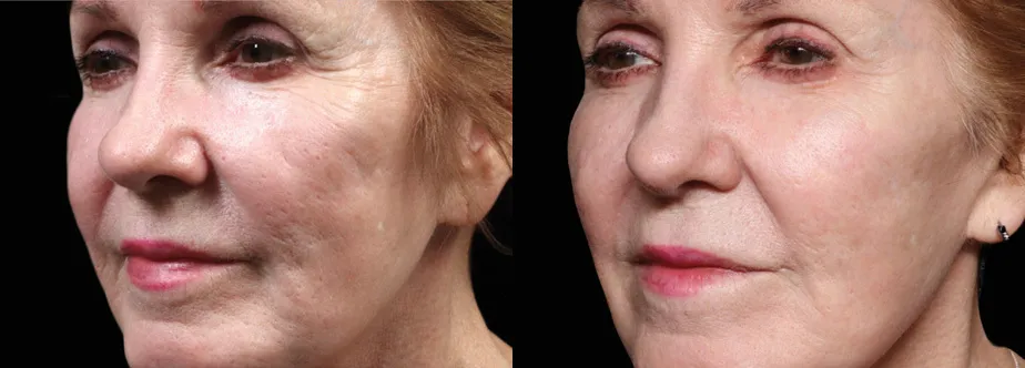 Exion RF Microneedling before and after