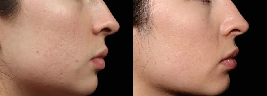 Exion RF Microneedling before and after