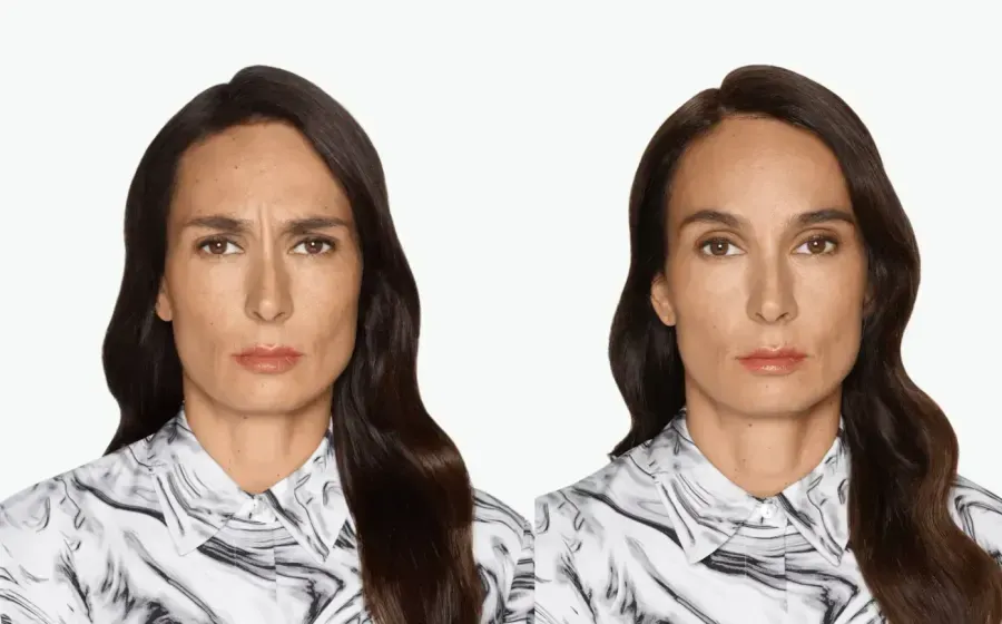 Botox before and after