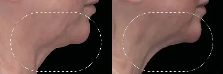 Emface before and after