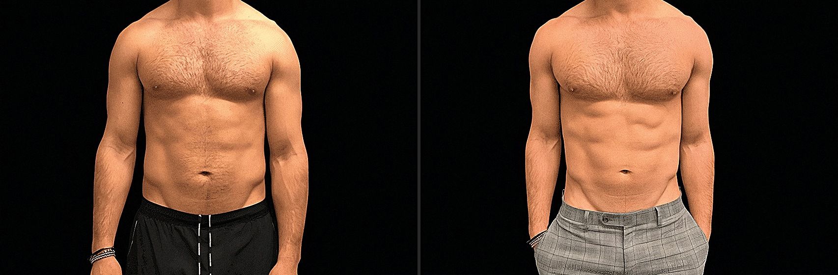 Emsculpt Neo - Before and After