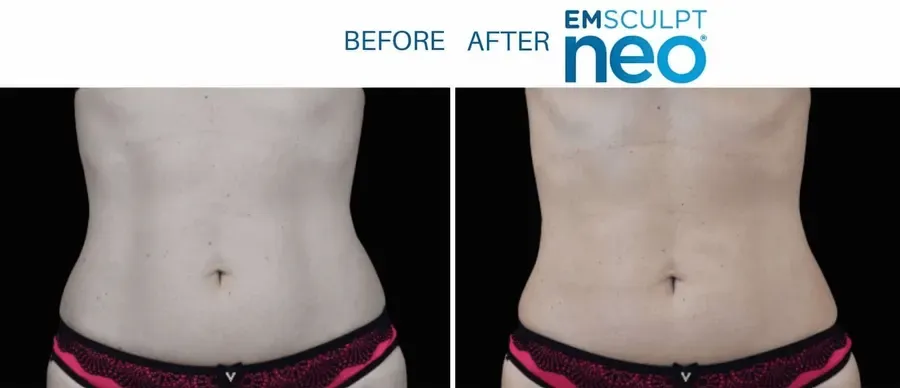 Emsculpt Neo before and after