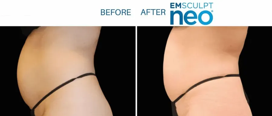 Emsculpt Neo before and after