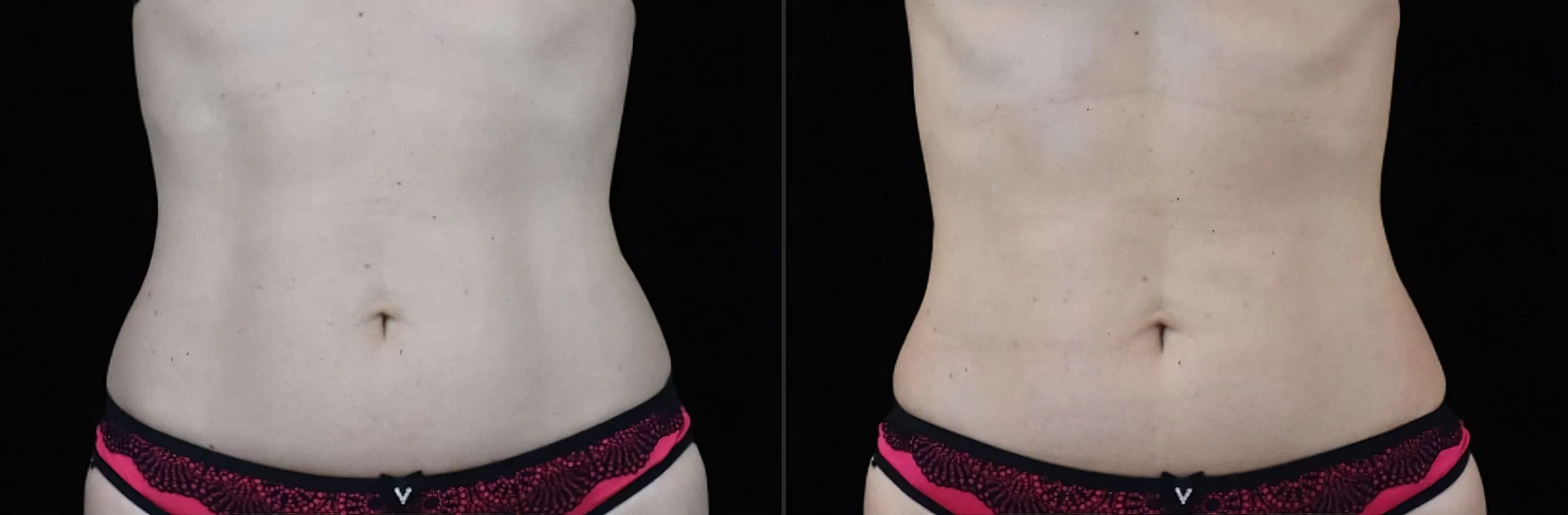 Emsculpt Neo - Before and After