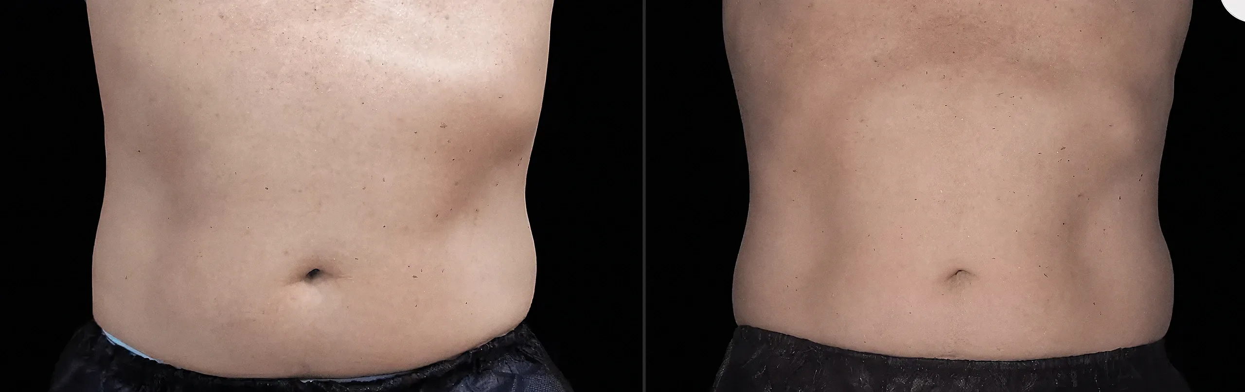 Emsculpt Neo - Before and After