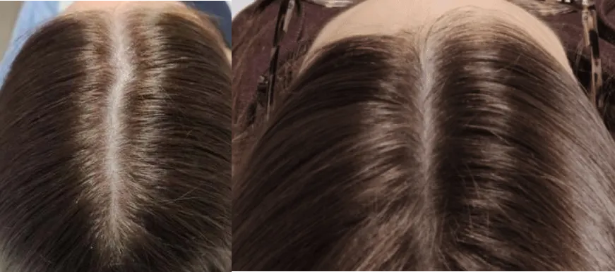 Folix Laser Hair Restoration before and after