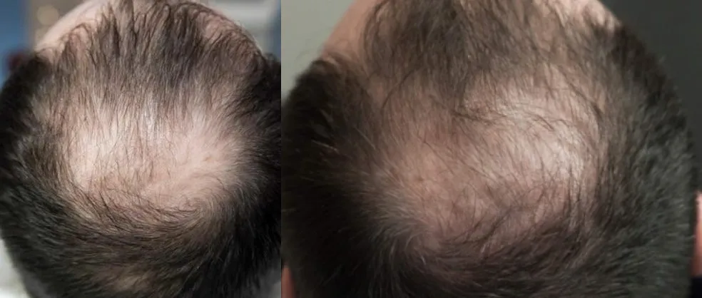 Folix Laser Hair Restoration before and after