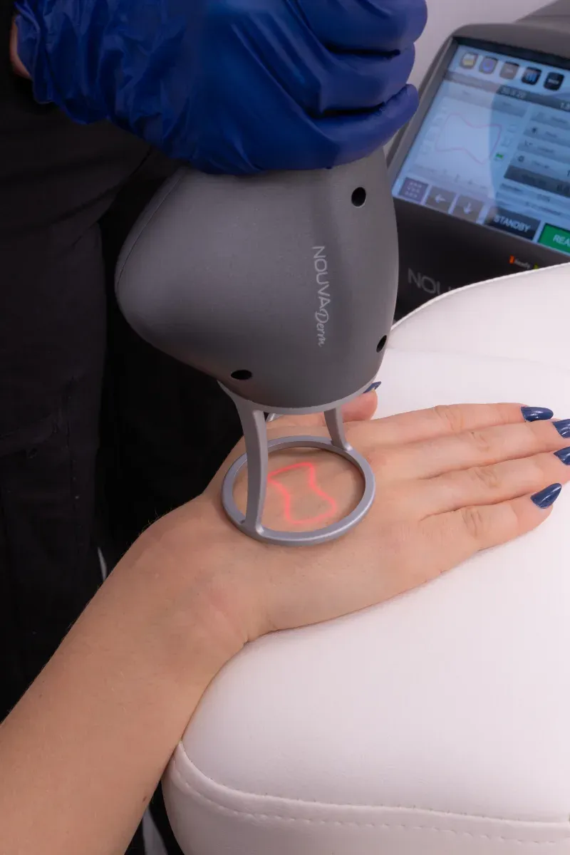 Diagram of fractional non-ablative laser columns in the skin during NOUVADerm resurfacing at Desert Oasis Wellness and Med Spa in Lake Havasu City