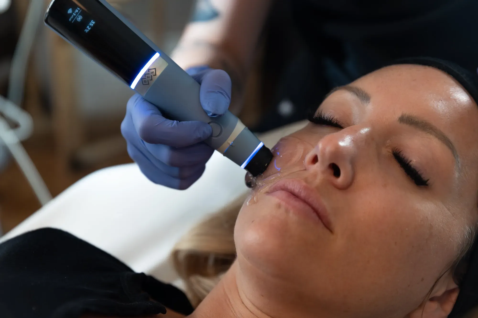 Exion Face applicator gliding across the cheek during a skin tightening session at Applegate MedSpa Covington