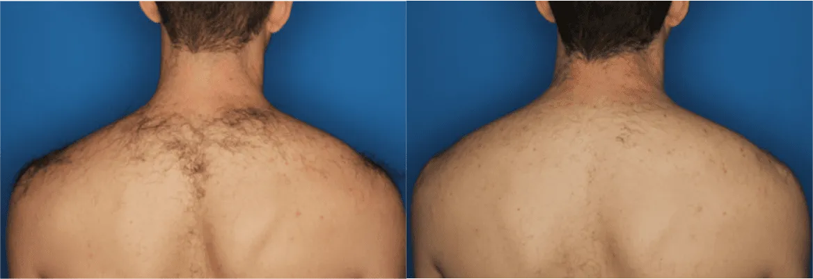 Splendor X before and after