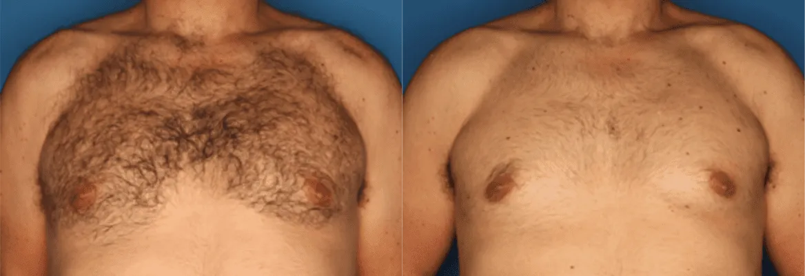 Splendor X before and after