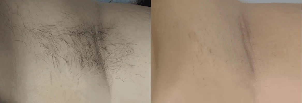 Splendor X before and after
