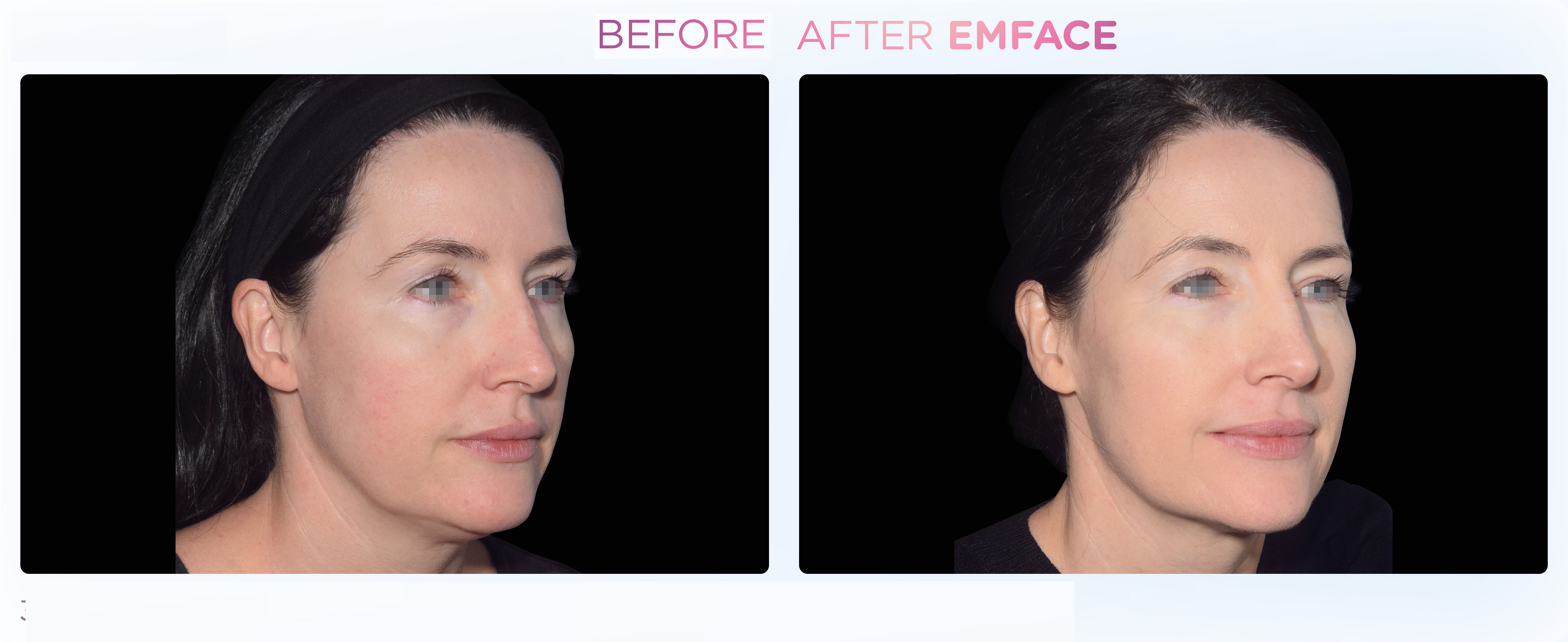 Emface - Before and After