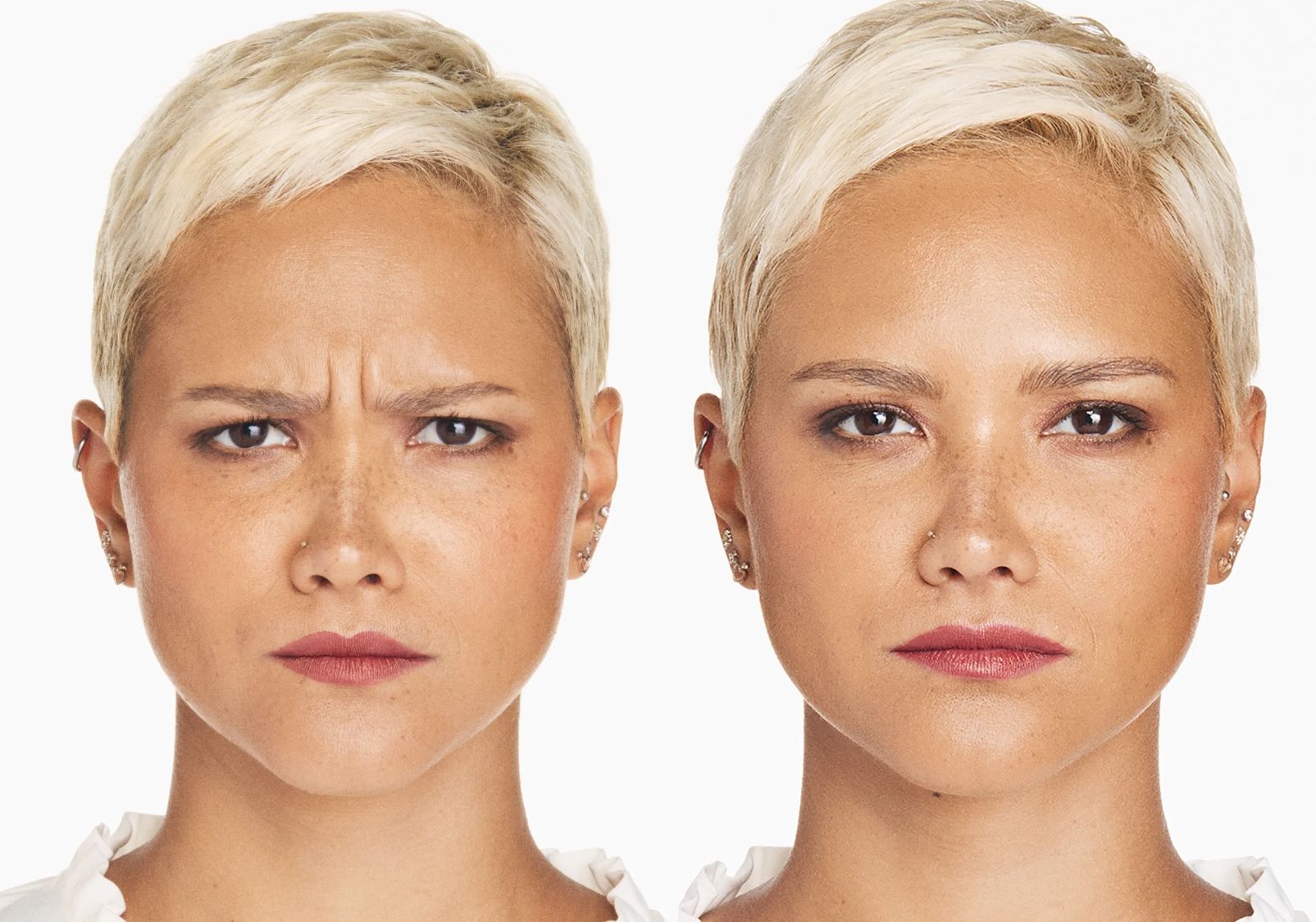 Xeomin effect on frown lines