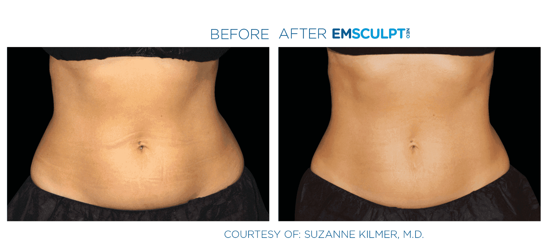 Emsculpt Neo effect on abdomen
