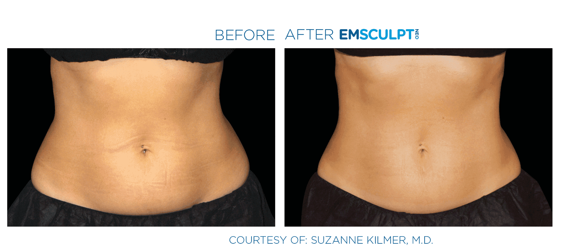 Emsculpt Neo effect on abdomen