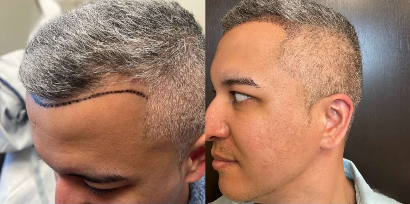 Artas  - Before and After