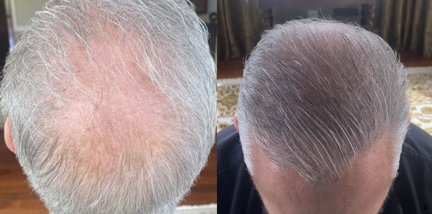Revian Laser Cap - Before and After