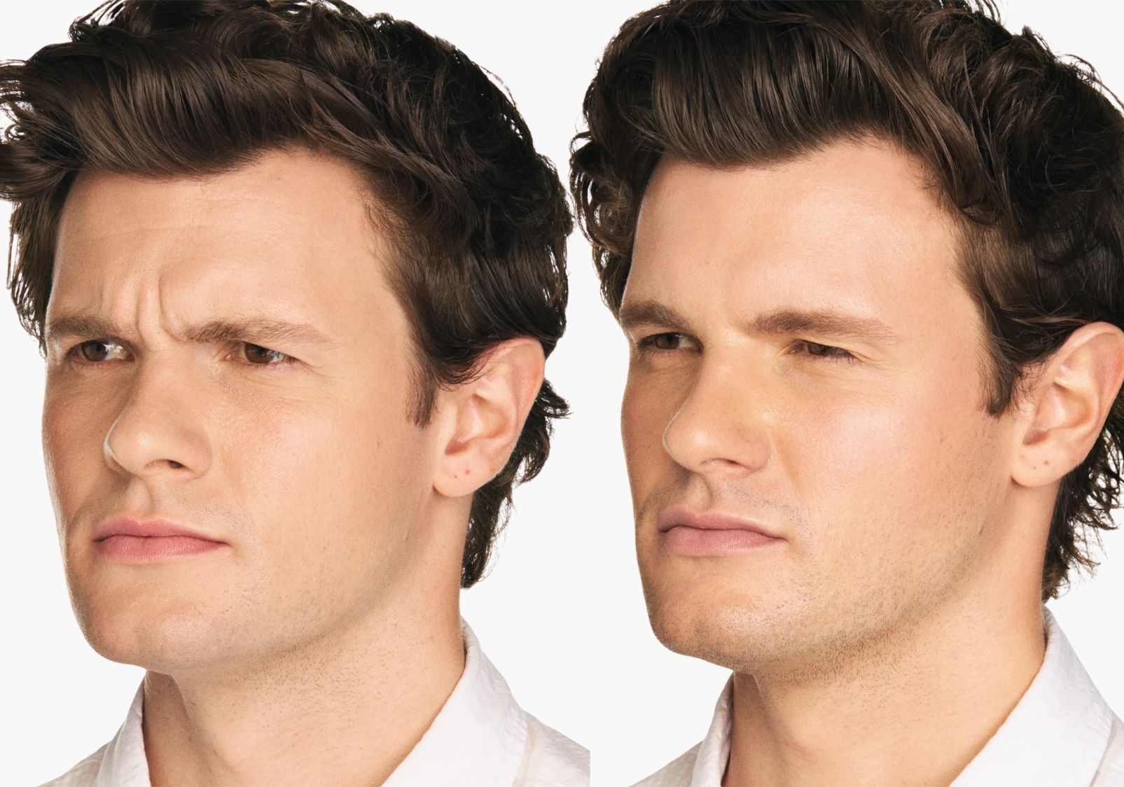 Xeomin effect on frown lines