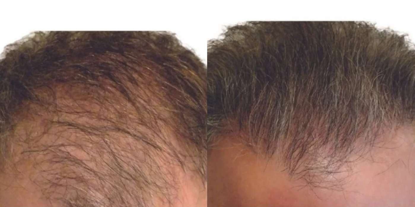 Artas  - Before and After