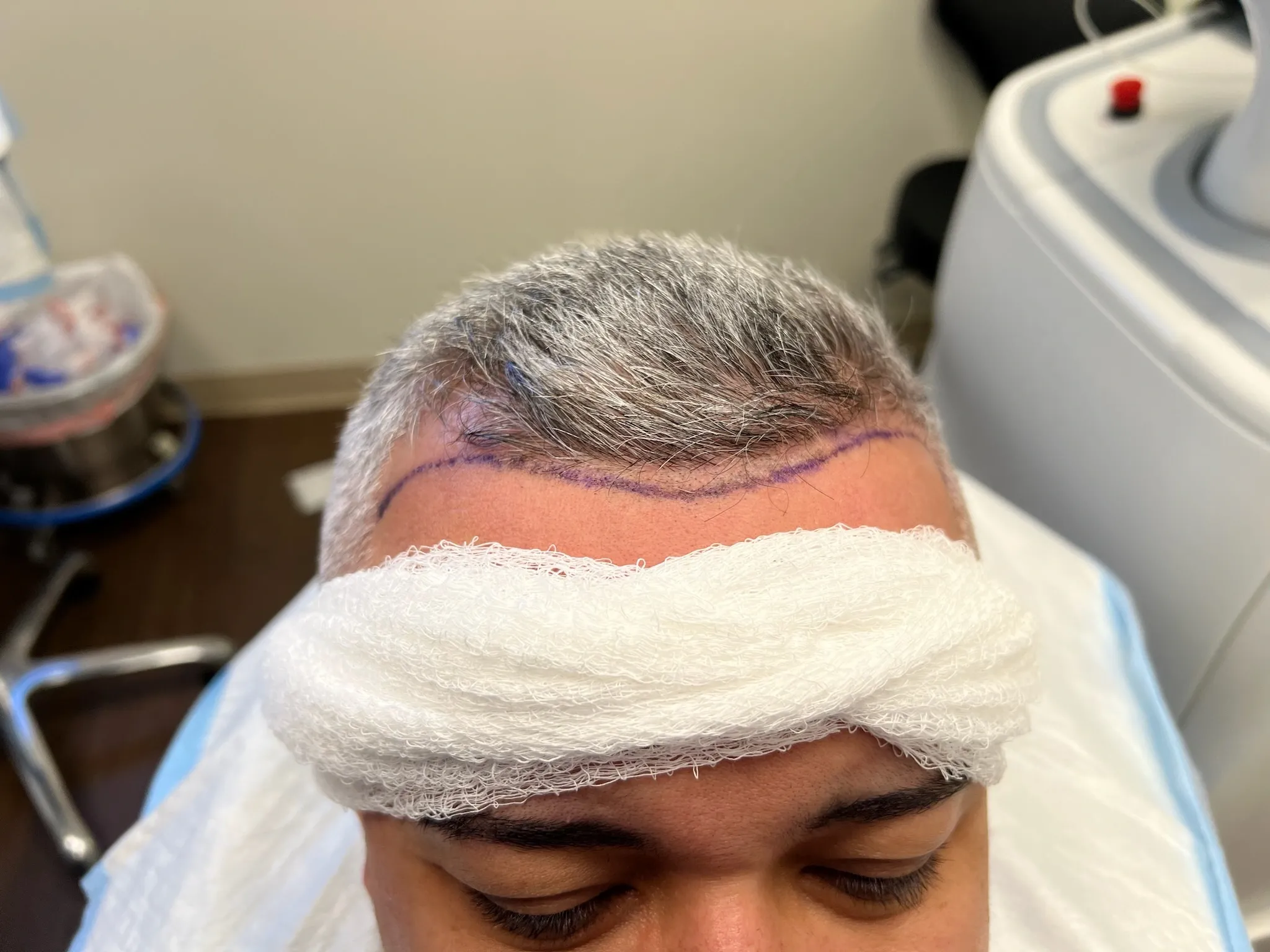 Hair transplant patient consultation at DSI Hair in Algonquin, IL