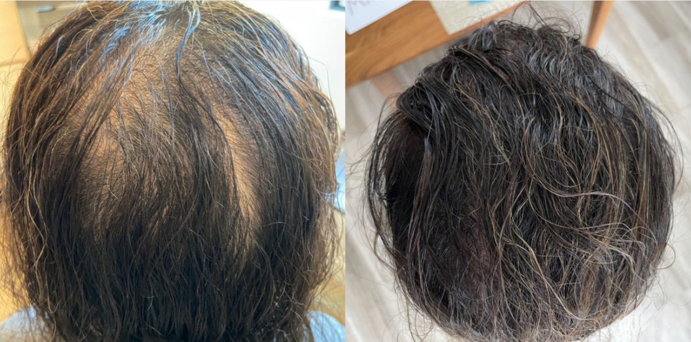 Revian Laser Cap - Before and After