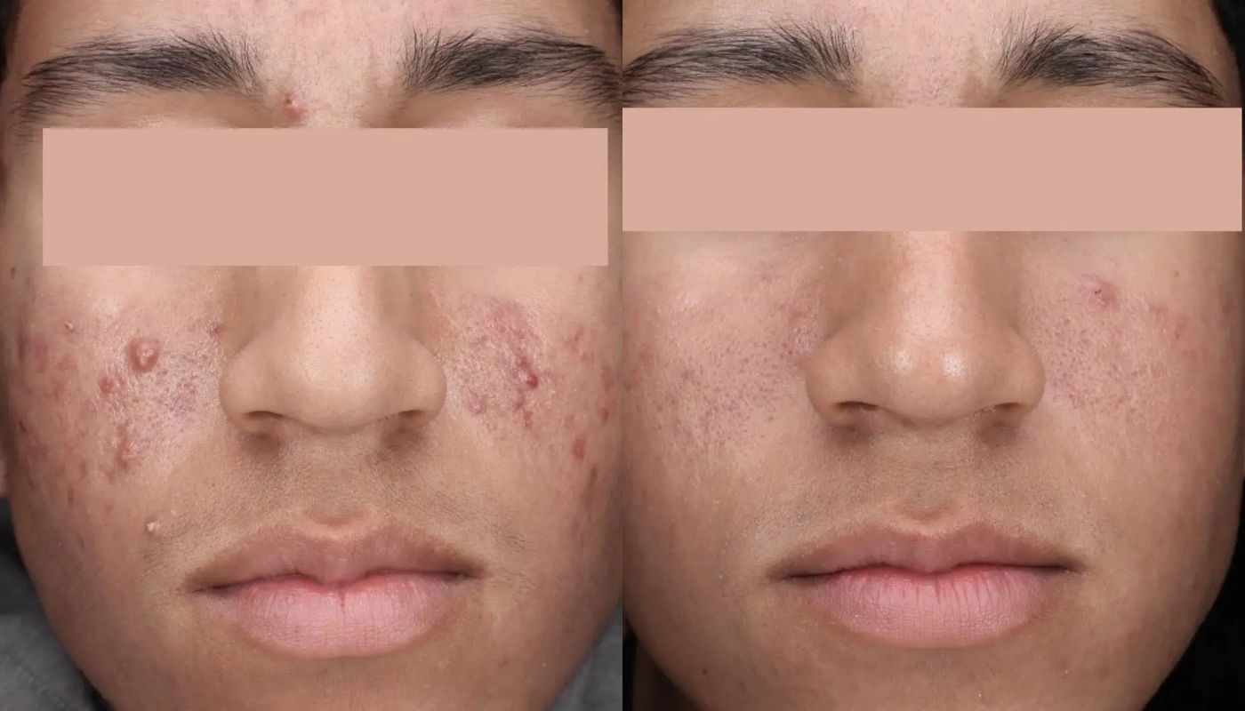 30 Minute Acne Facial before and after