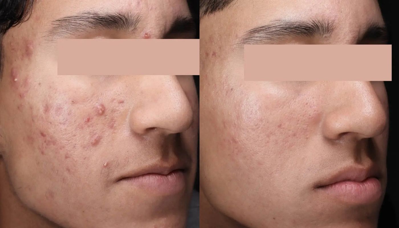 30 Minute Acne Facial before and after