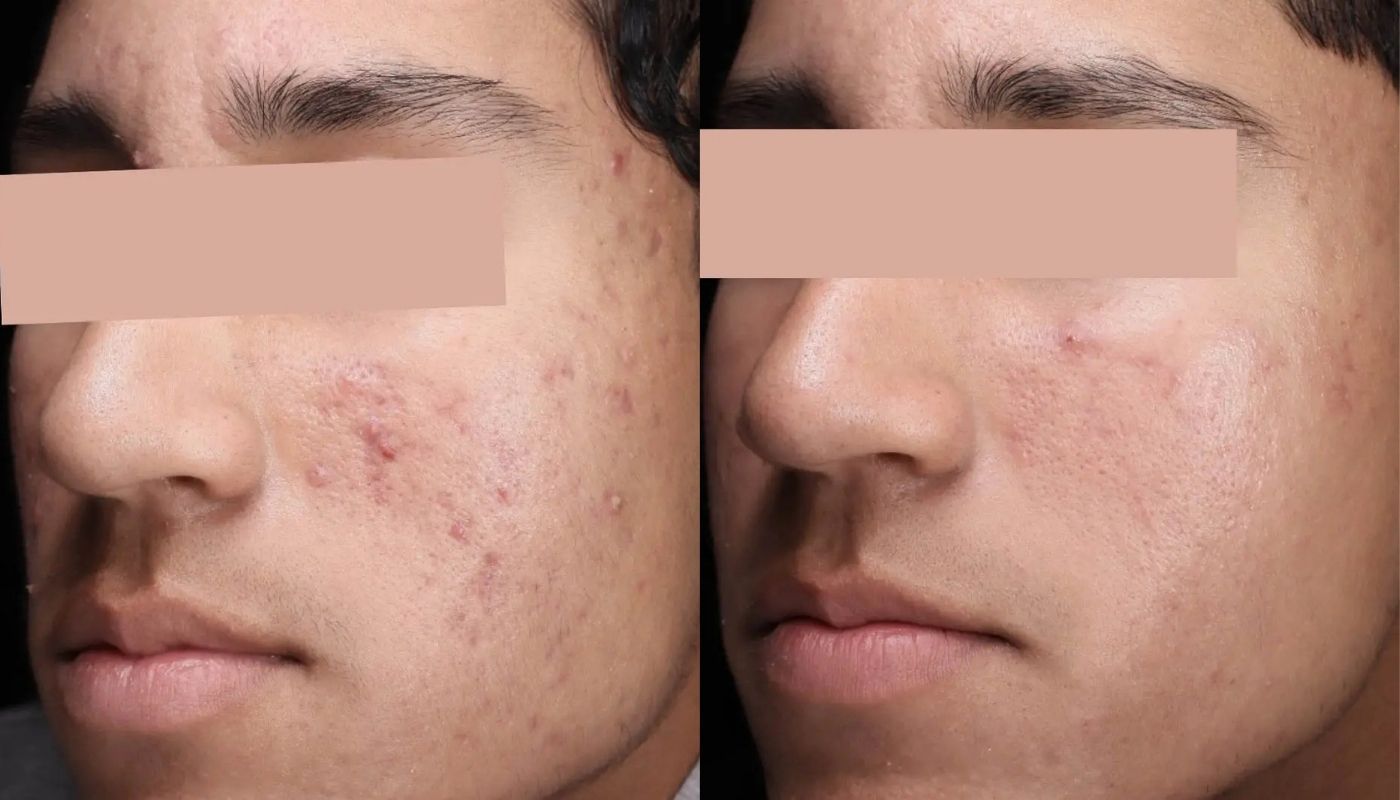 30 Minute Acne Facial before and after
