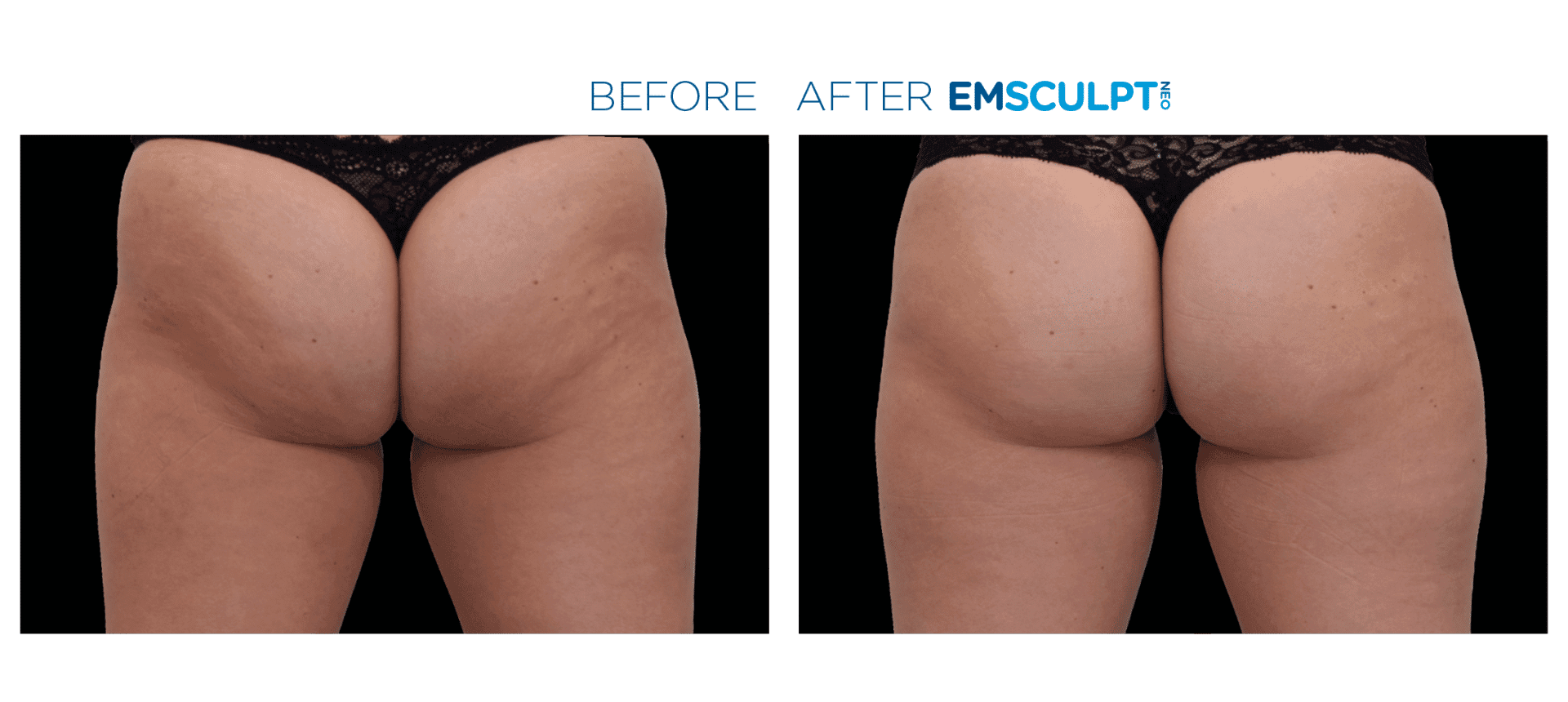 Emsculpt Neo - Before and After