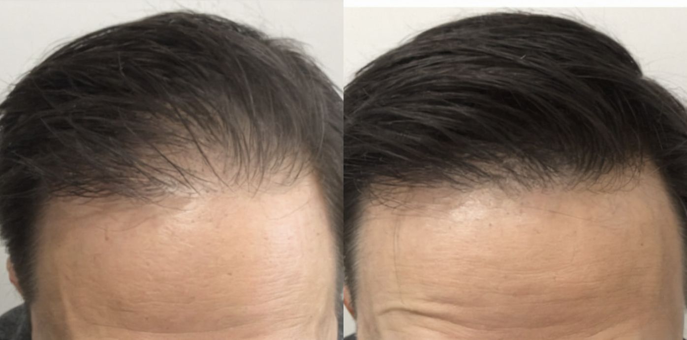 PRP - Before and After