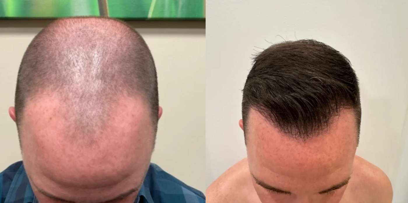 Artas  - Before and After