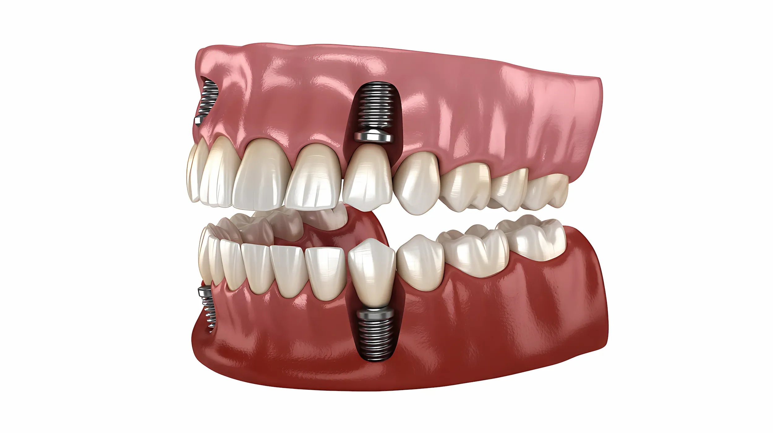 Single tooth implant procedure at Dental World in Longwood Florida