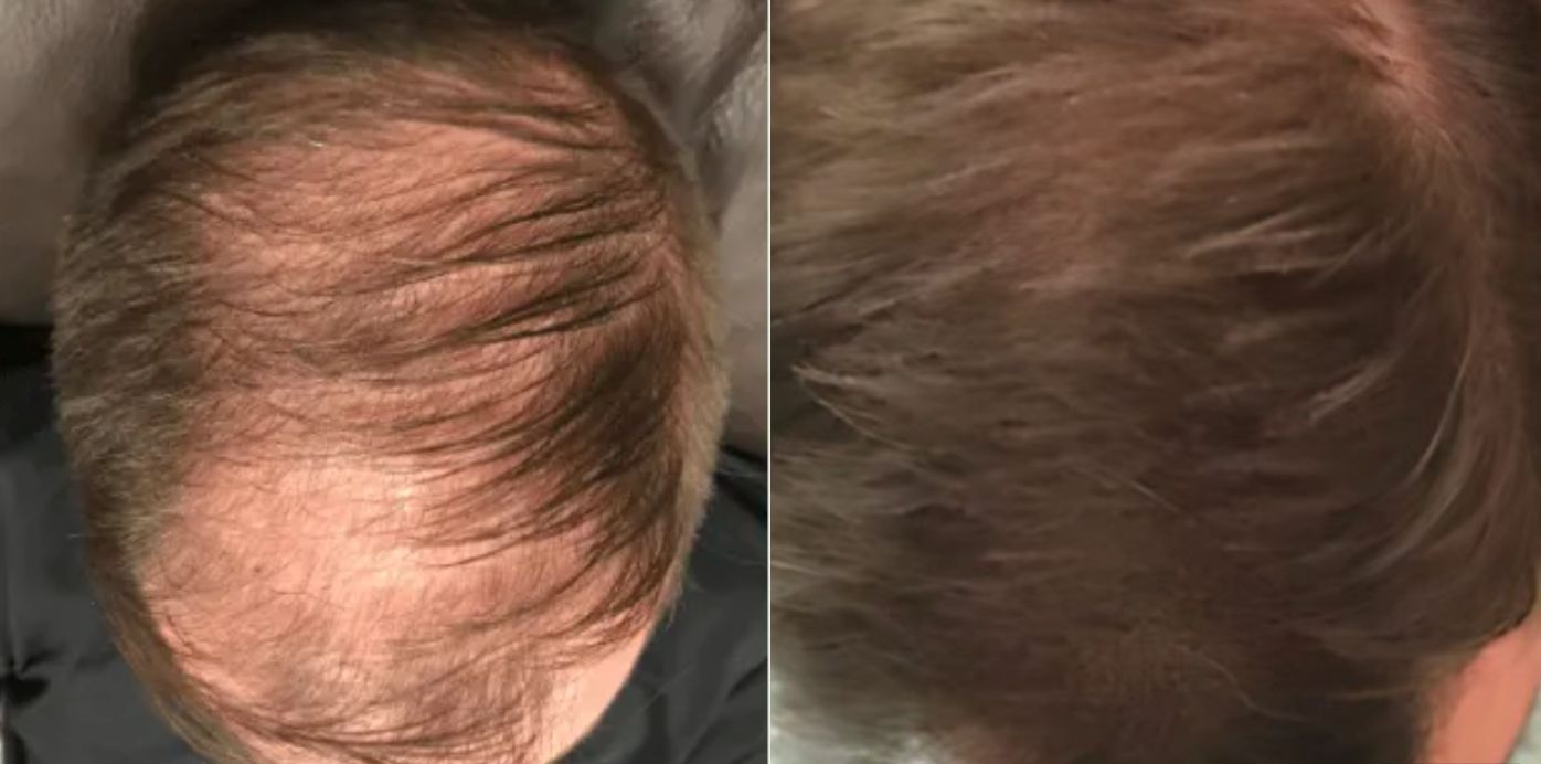 Finasteride - Before and After