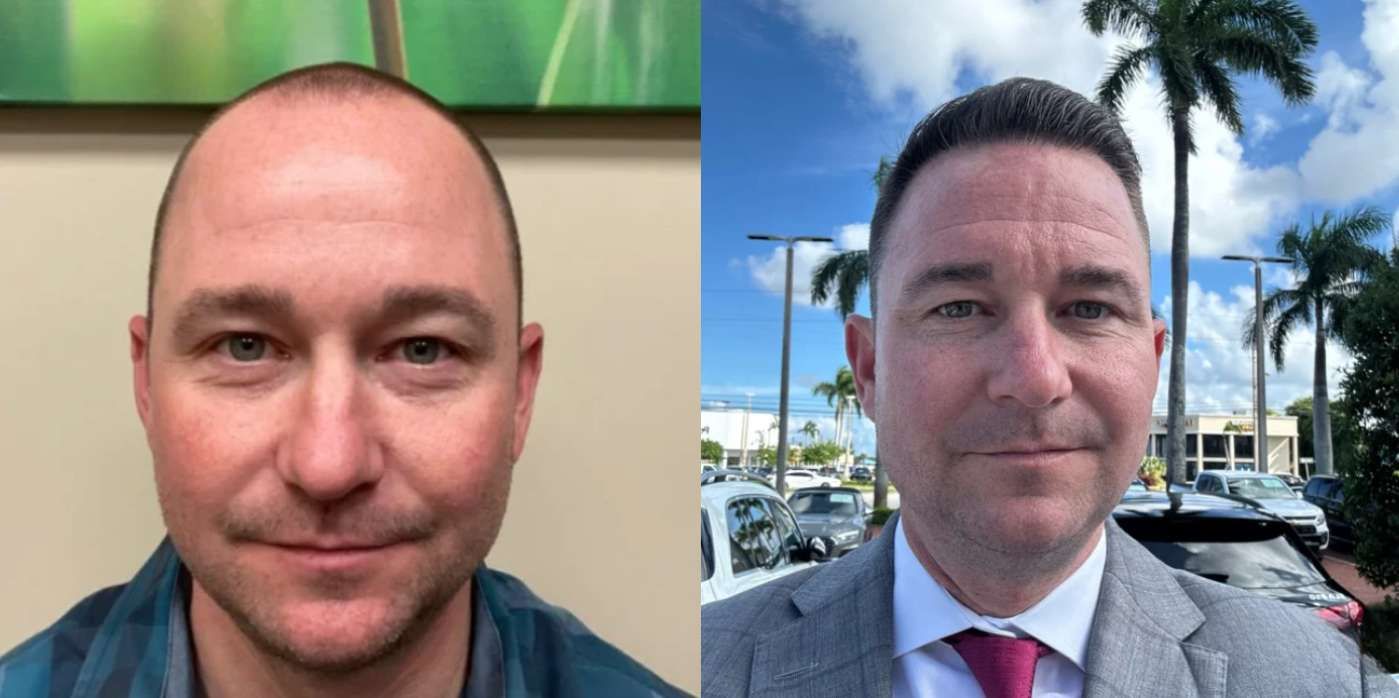 Artas  - Before and After