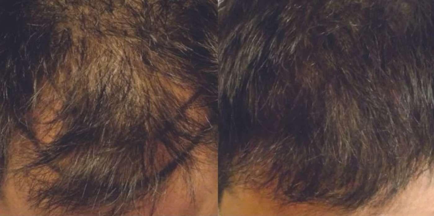 Artas  - Before and After