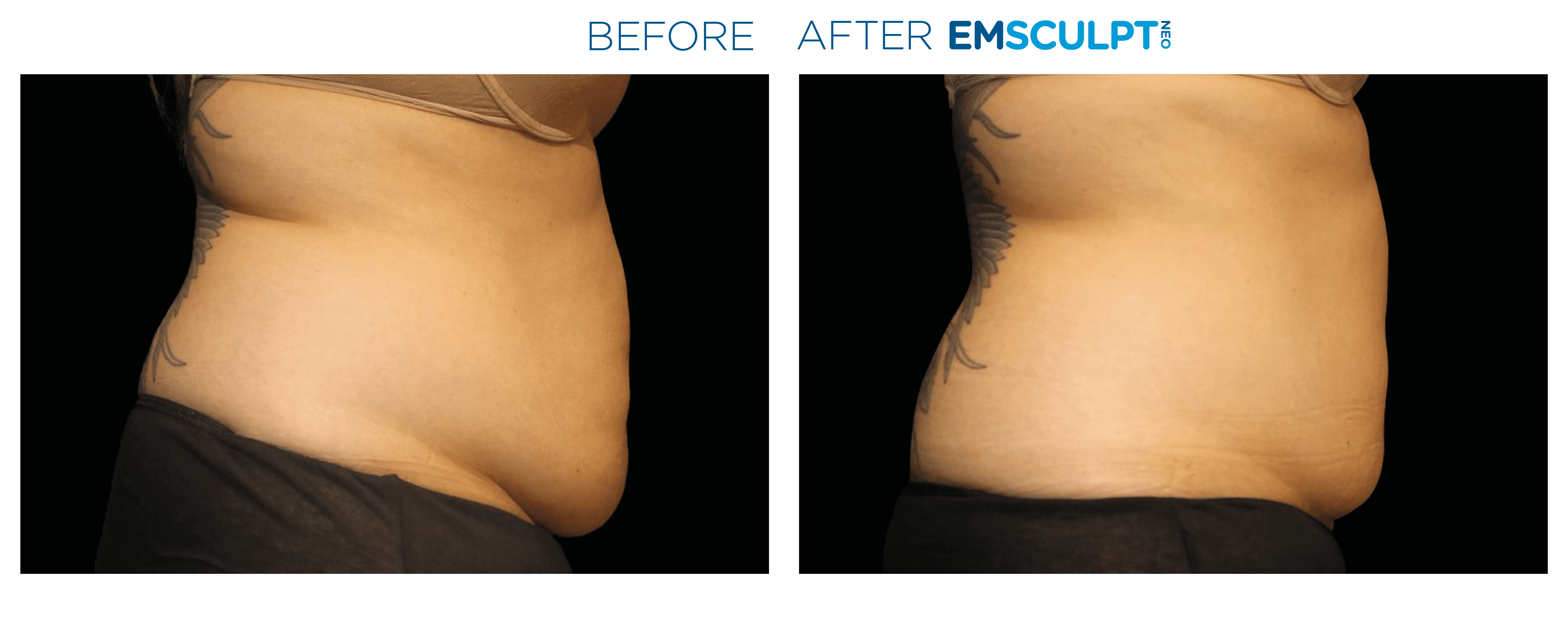 Emsculpt Neo - Before and After