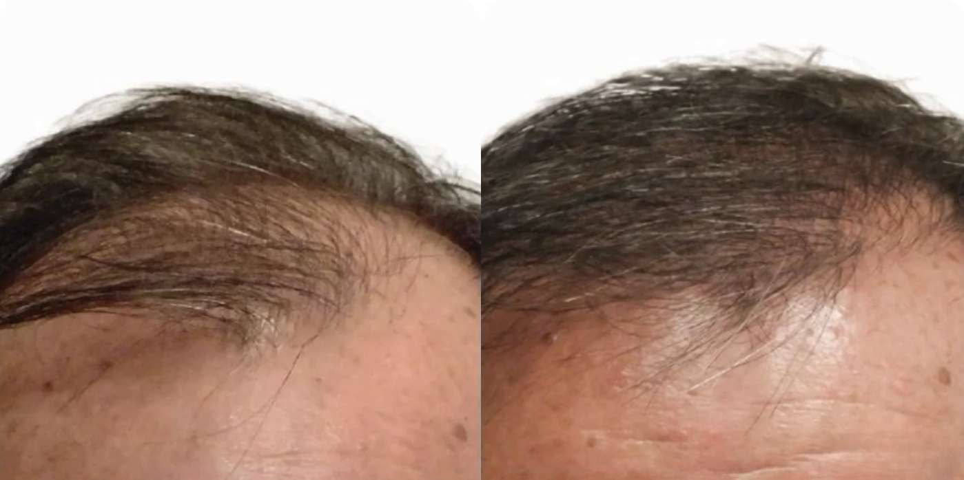 Artas  - Before and After