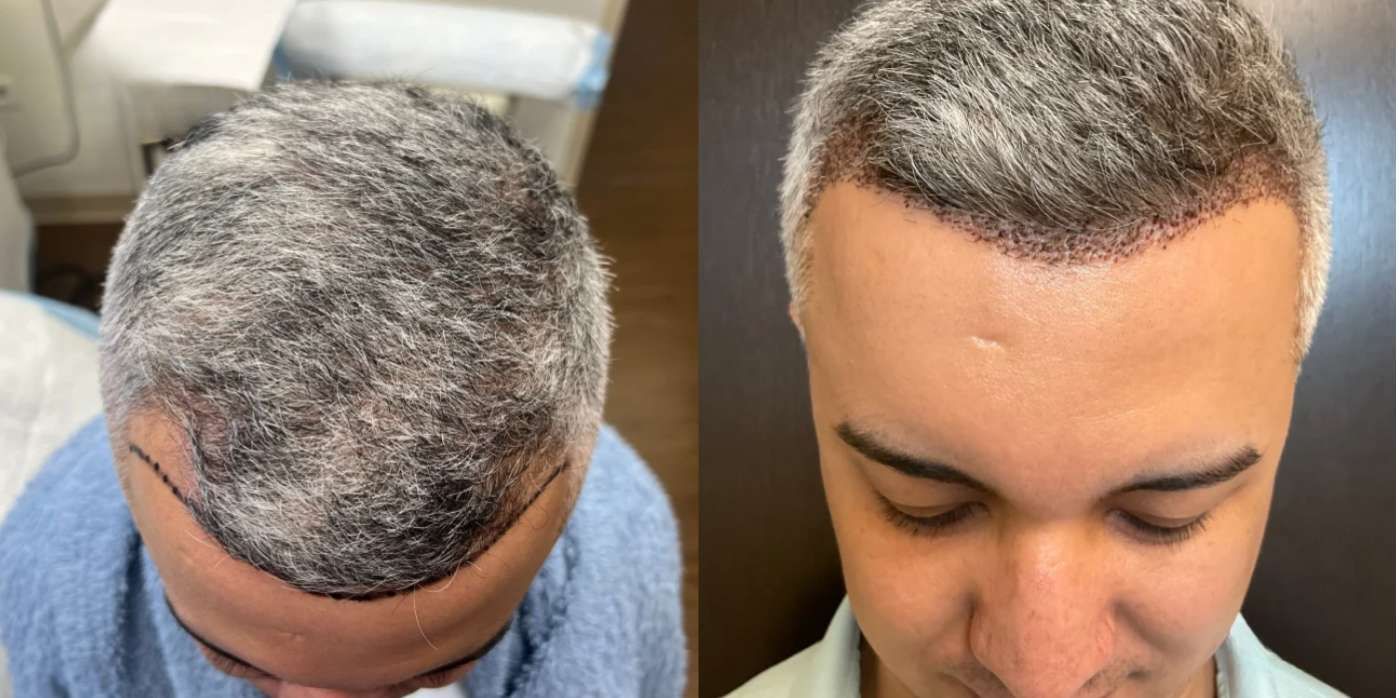 Artas  - Before and After