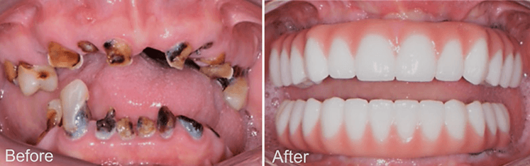 All-on-X Dental Implants - Before and After