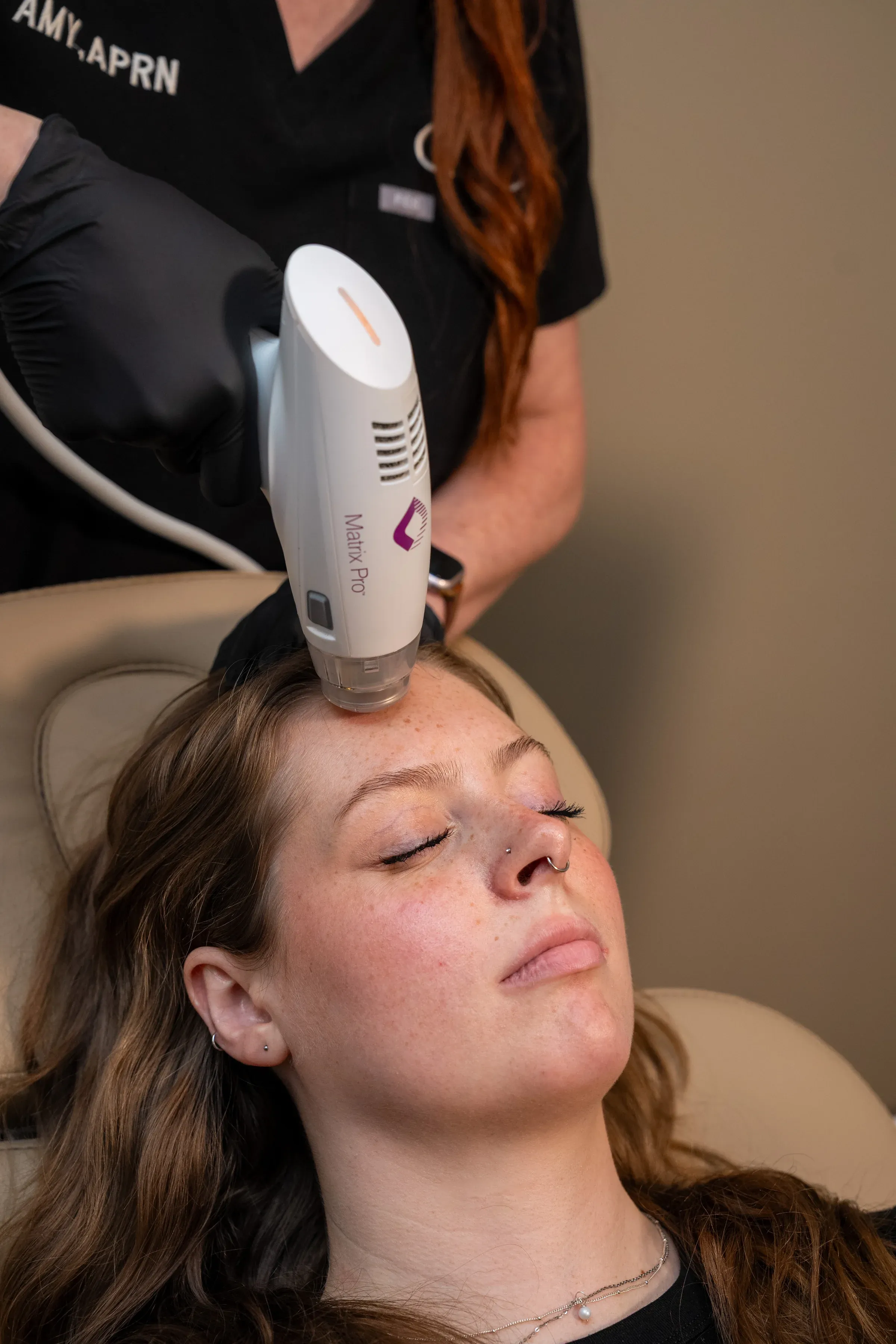 Before and after RF Microneedling transformation