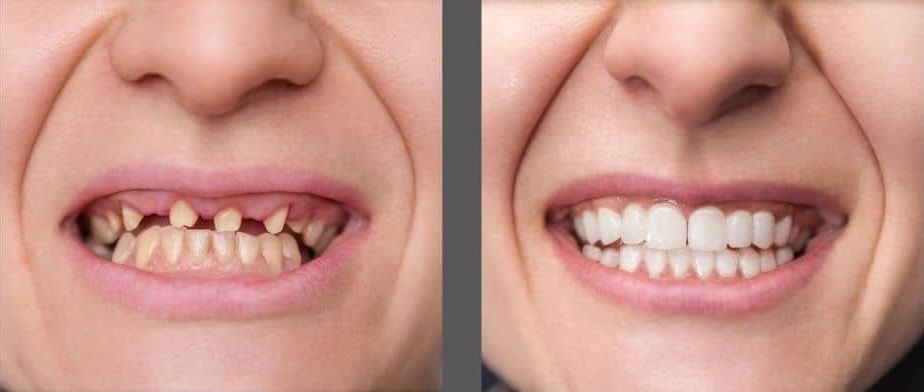 All-on-X Dental Implants - Before and After