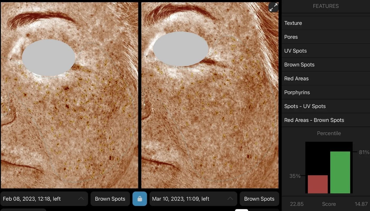 BBL - Before and After