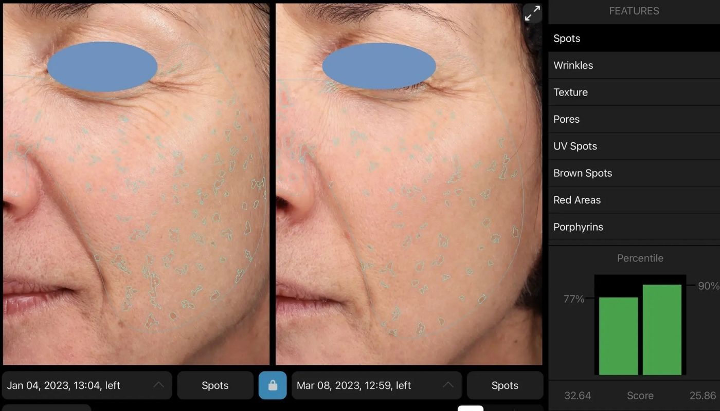 BBL - Before and After